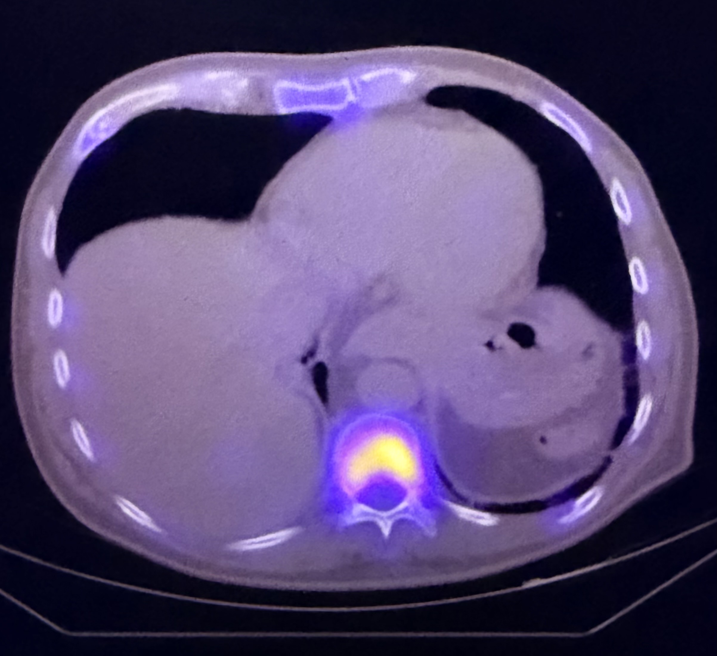 PET/CT example used to illustrate advanced cancer staging and treatment response assessment